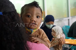 Kenali Kelainan Bibir Sumbing dan Cara Penanganan